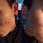 [心得] 台南林炳煌皮膚科 – 痘痘看診、初診心得